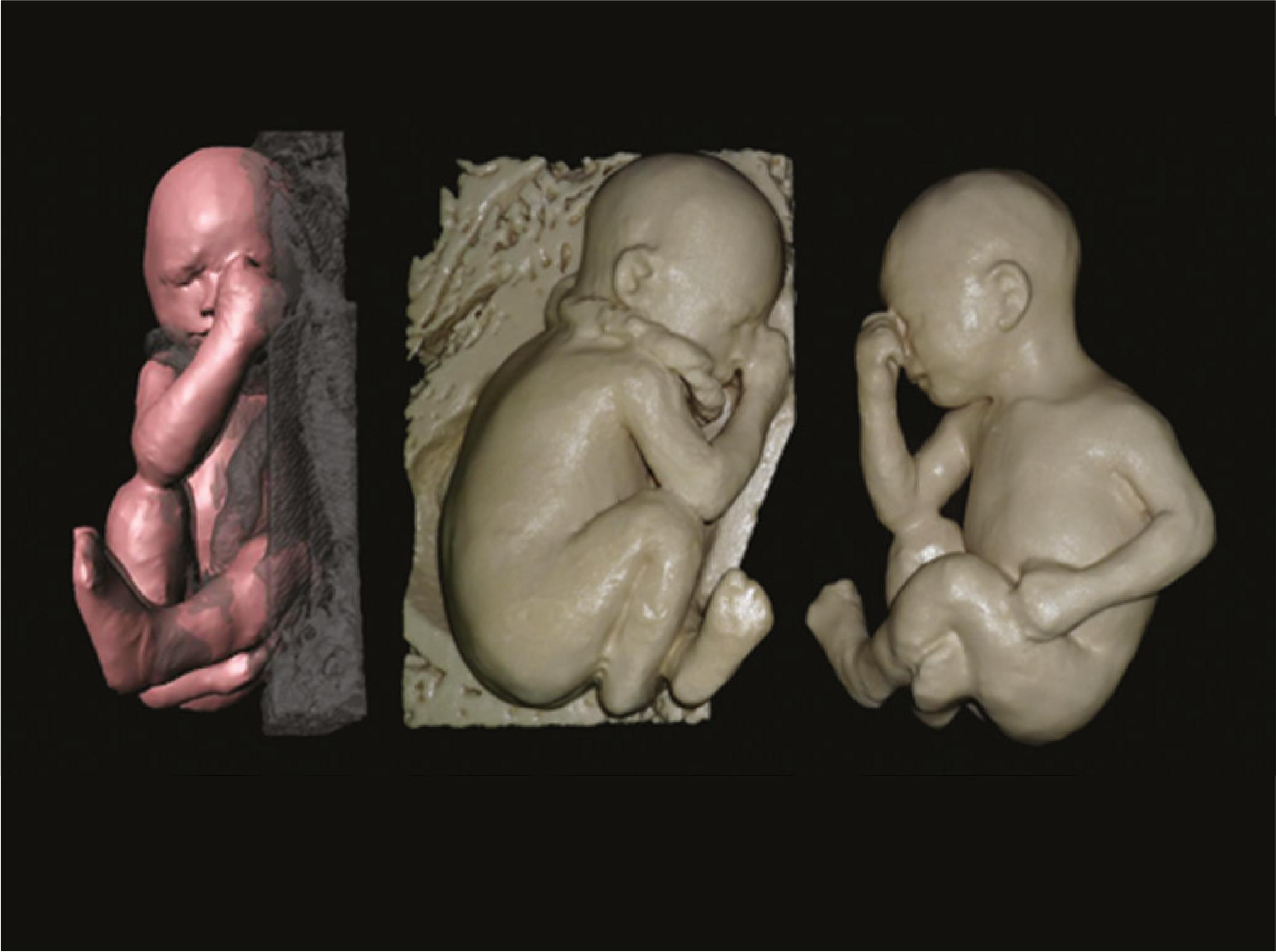 ブラジルのクリニックが胎児の3Dモデリングを実施